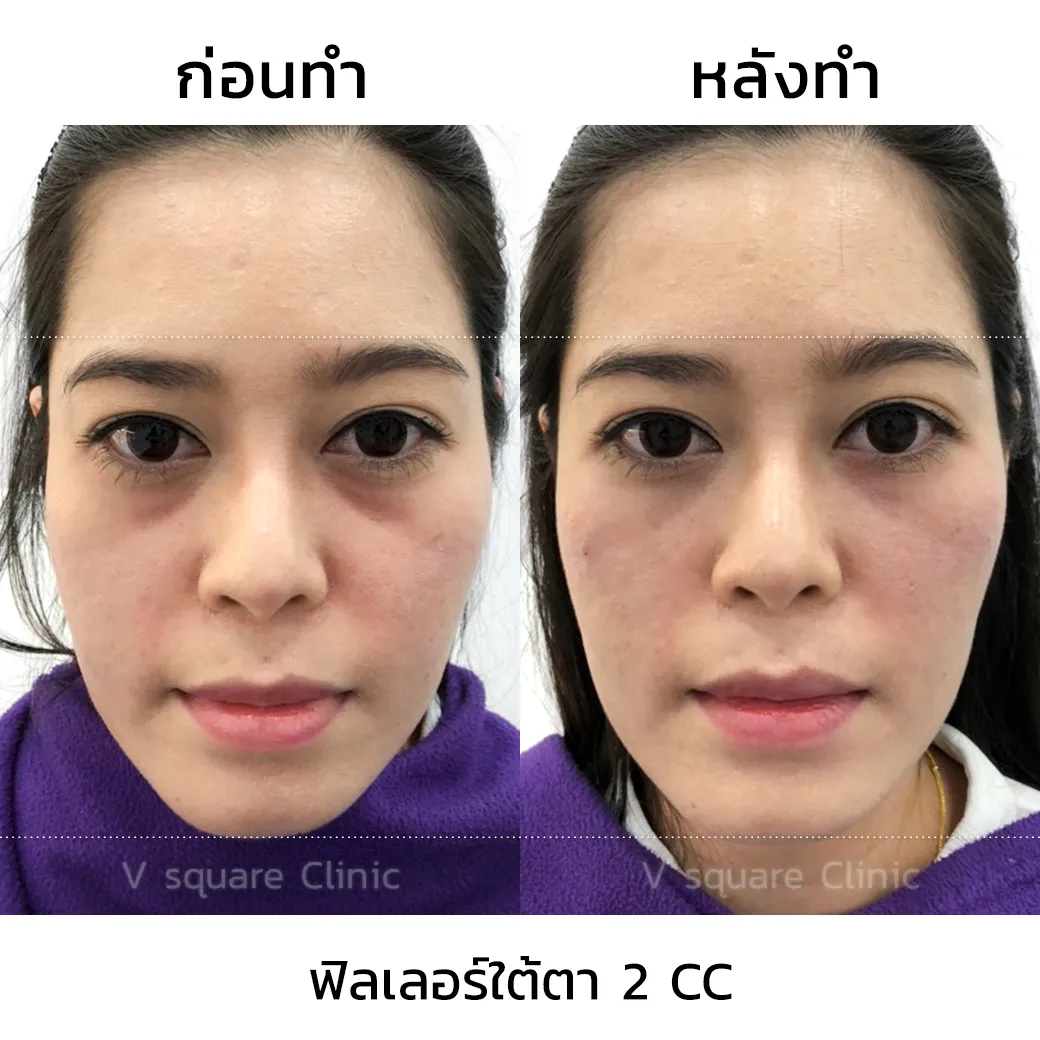 รีวิวฟิลเลอร์ใต้ตา