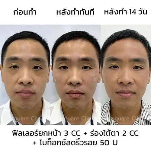 รีวิวฟิลเลอร์ใต้ตา ก่อน - หลังทำ 2 สัปดาห์