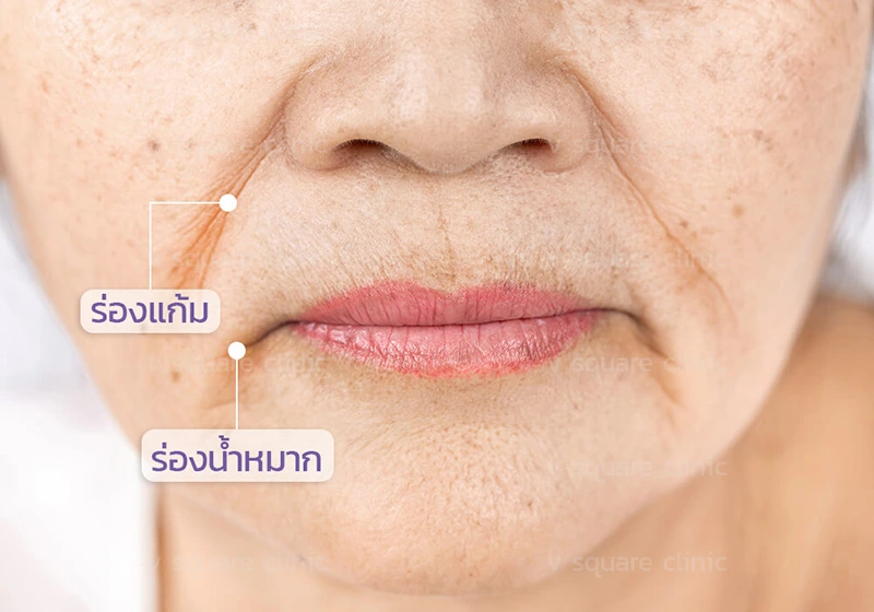 ร่องน้ำหมากกับร่องแก้ม ต่างกันอย่างไร