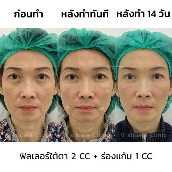 รีวิวฟิลเลอร์ตา