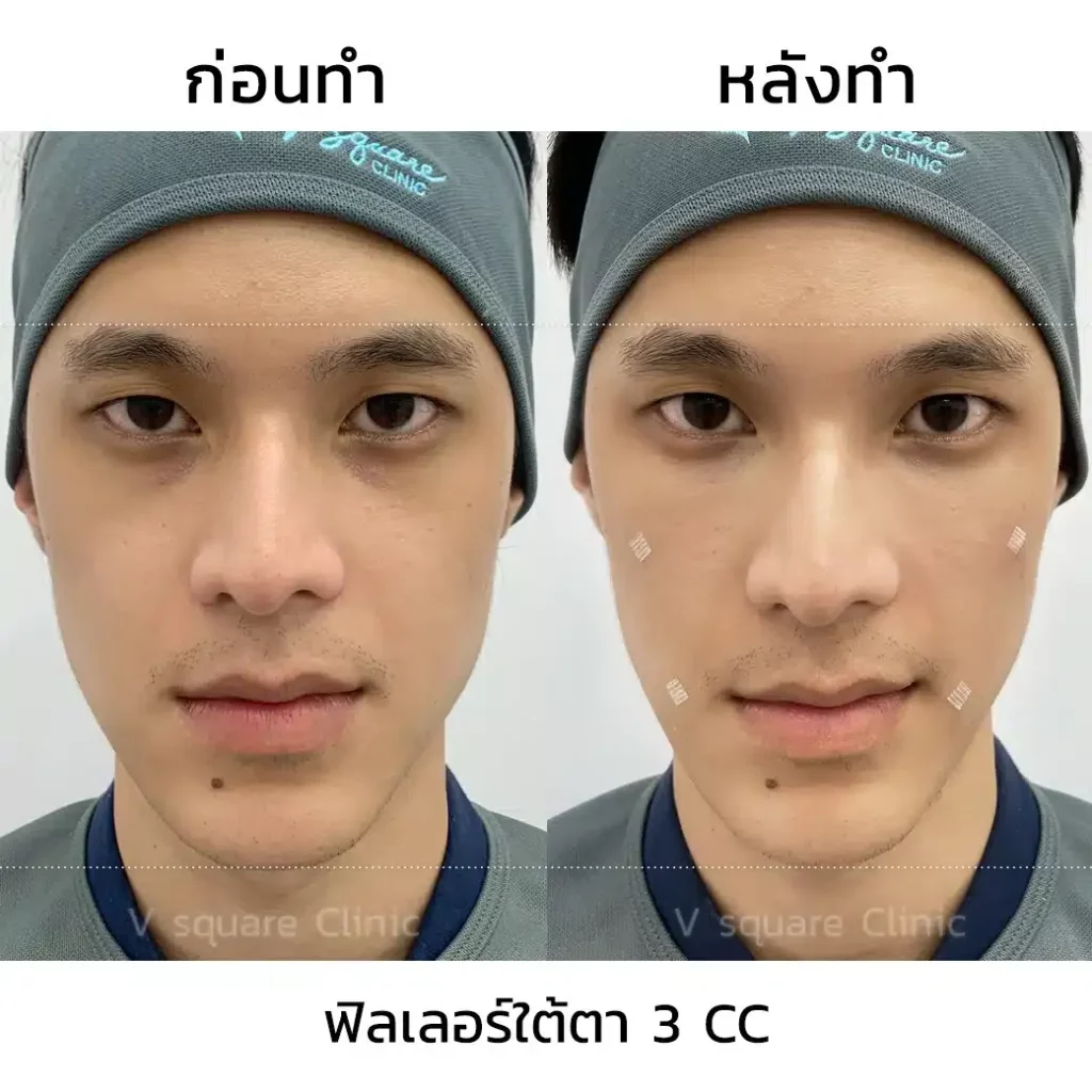 รีวิวฟิลเลอร์ตา