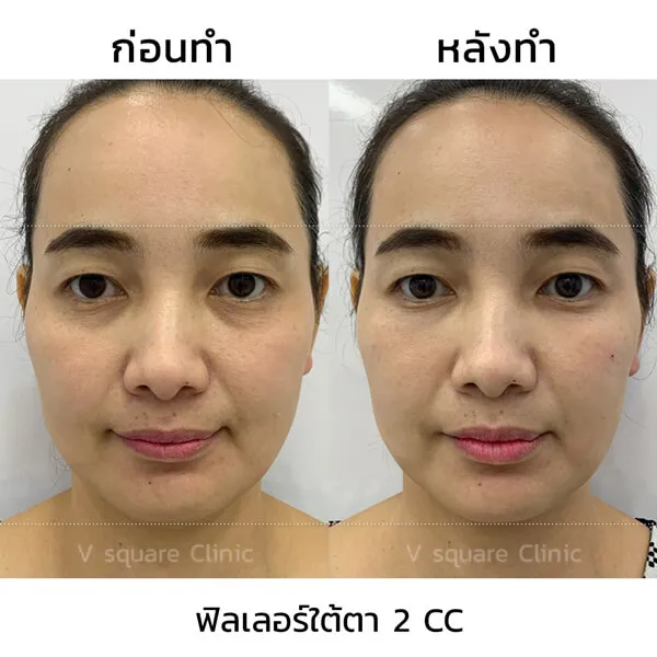 รีวิวฟิลเลอร์ตา