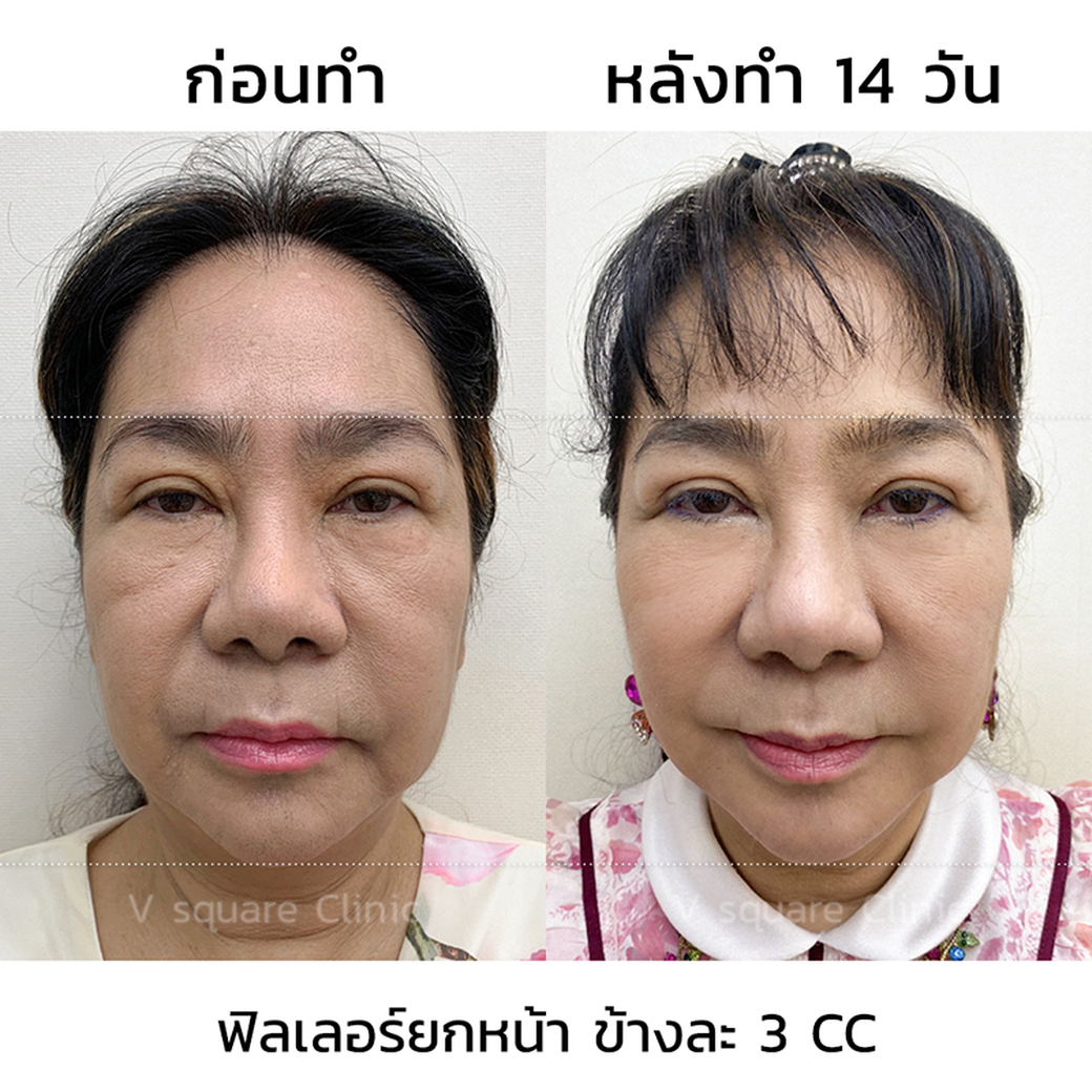 รีวิว ฟิลเลอร์ยกหน้า