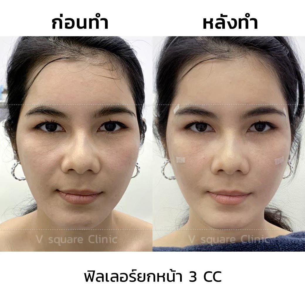 รีวิว ฟิลเลอร์ยกหน้า