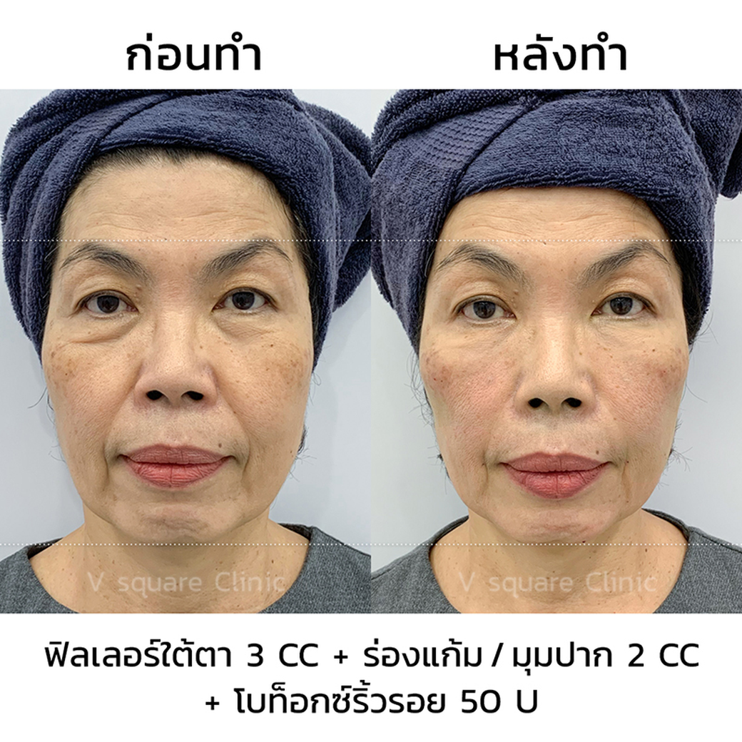 รีวิว ฟิลเลอร์ยกหน้า