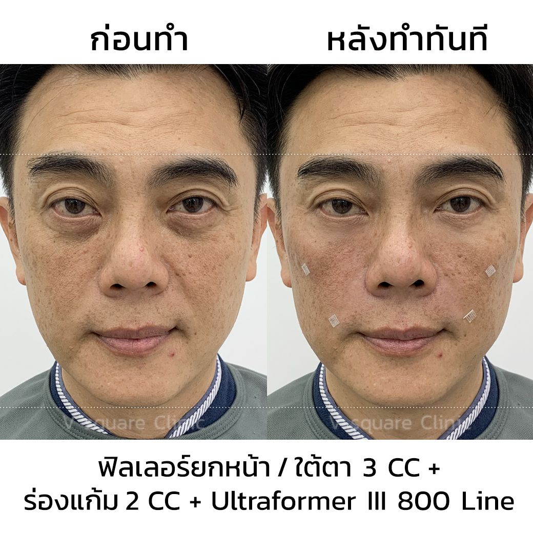 รีวิว ฟิลเลอร์ยกหน้า