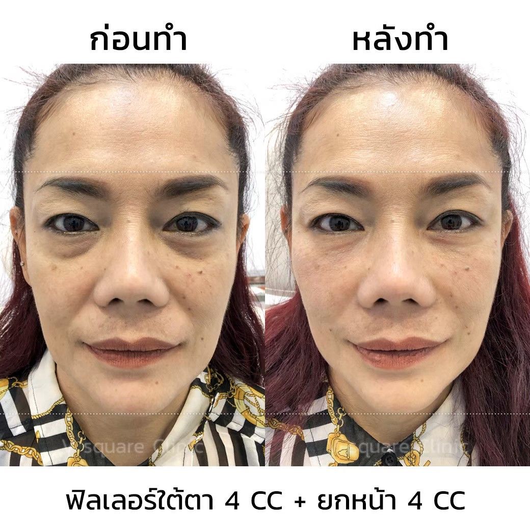 รีวิว ฟิลเลอร์ยกหน้า