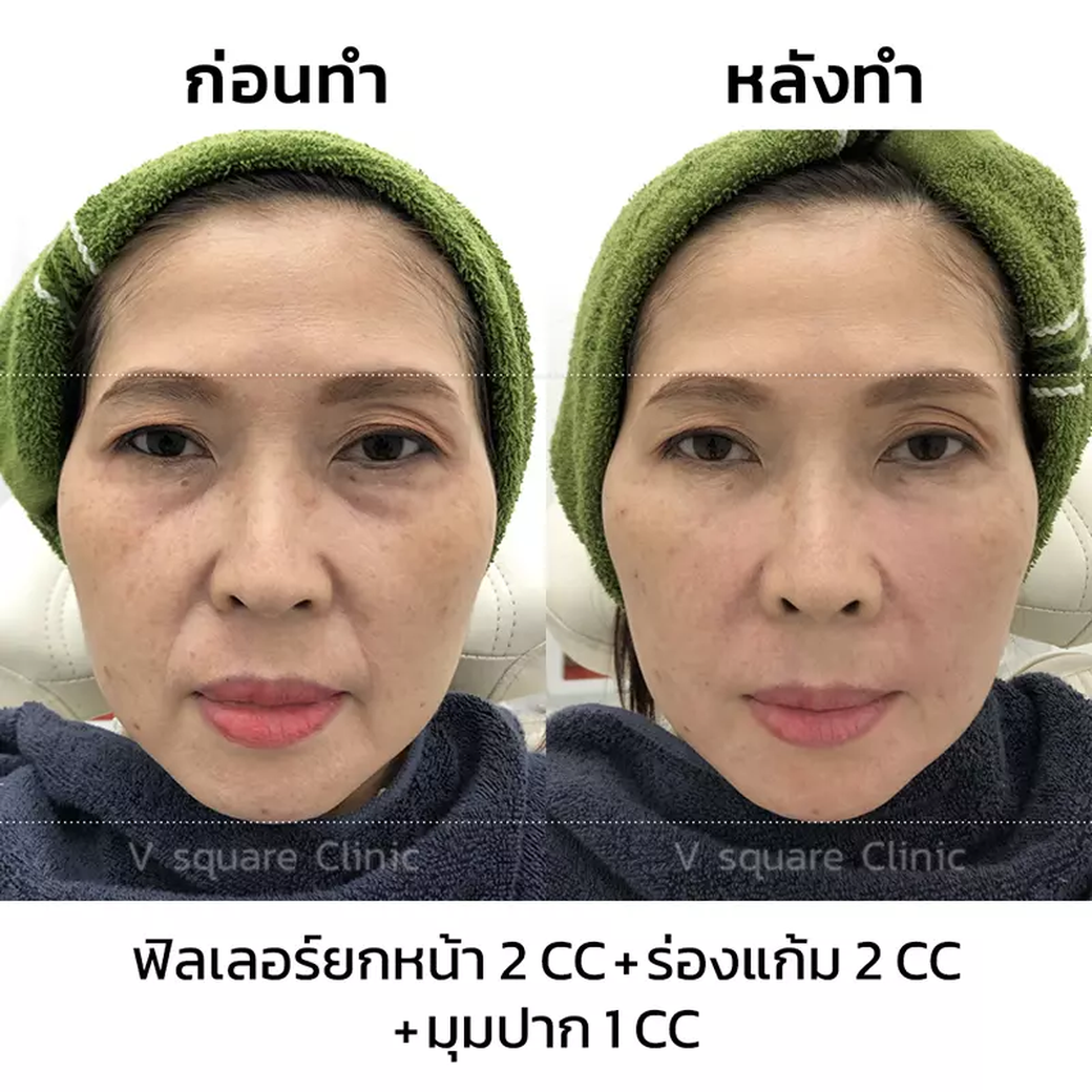 รีวิว ฟิลเลอร์ยกหน้า