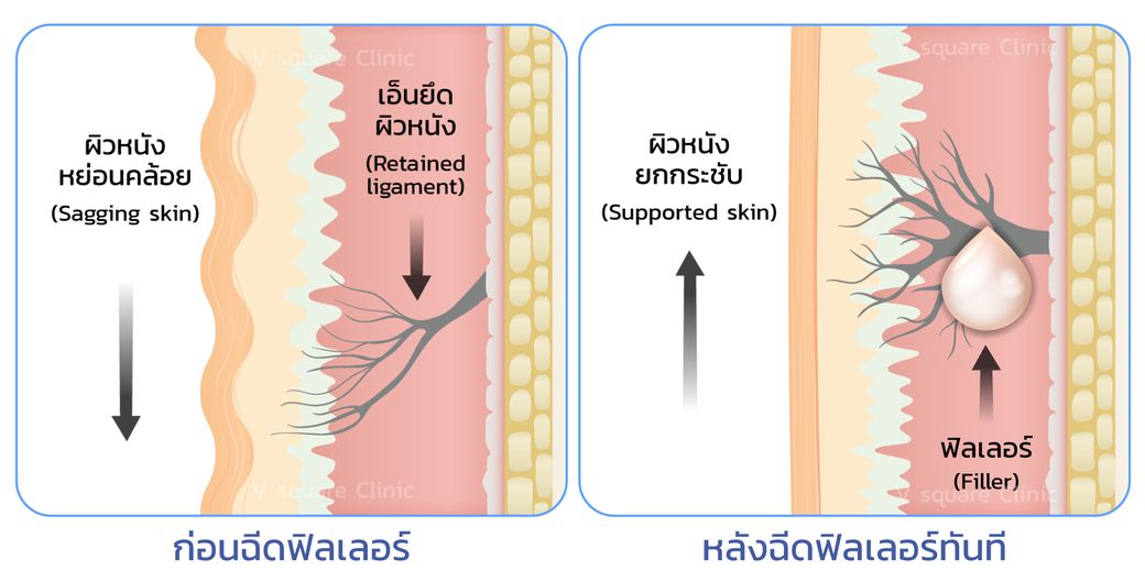 เทคนิคฉีดฟิลเลอร์ยกหน้า