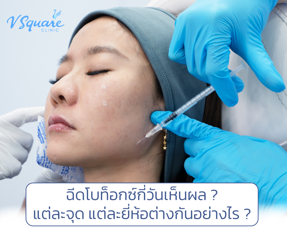 ฉีดโบท็อกกี่วันเห็นผล