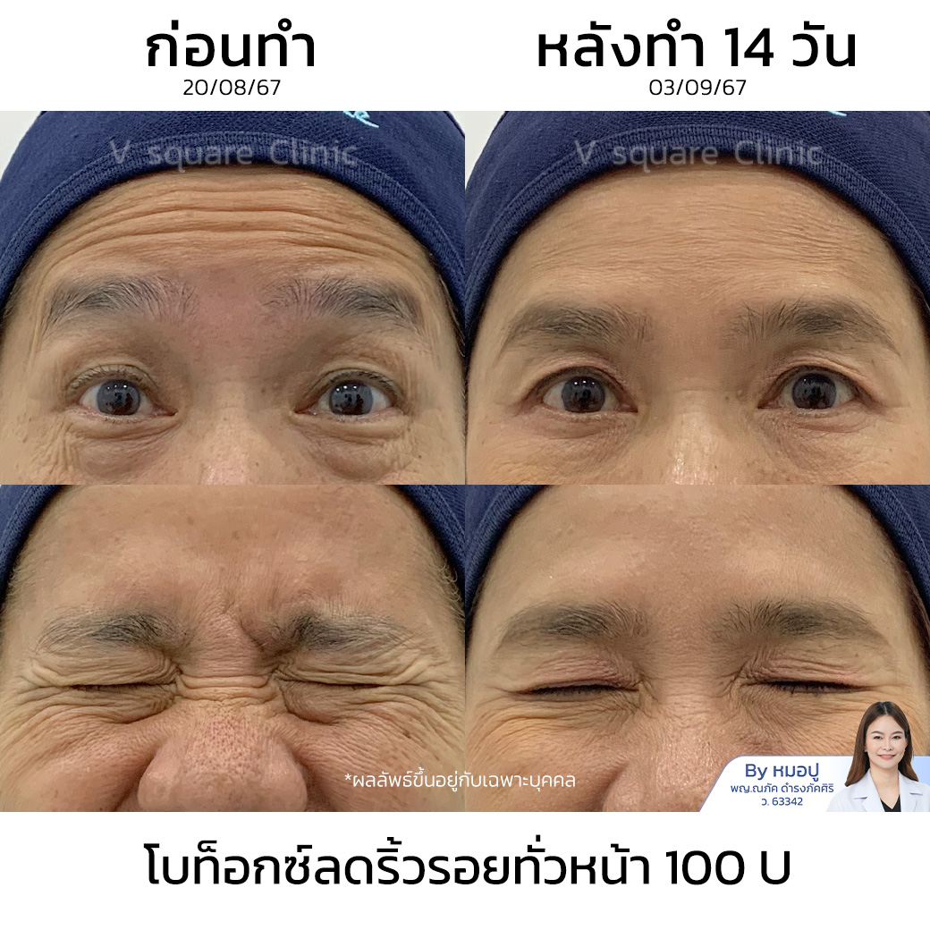 หลังฉีดโบท็อกกี่วันเห็นผล