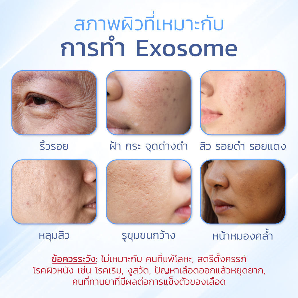 exosome เหมาะกับใคร