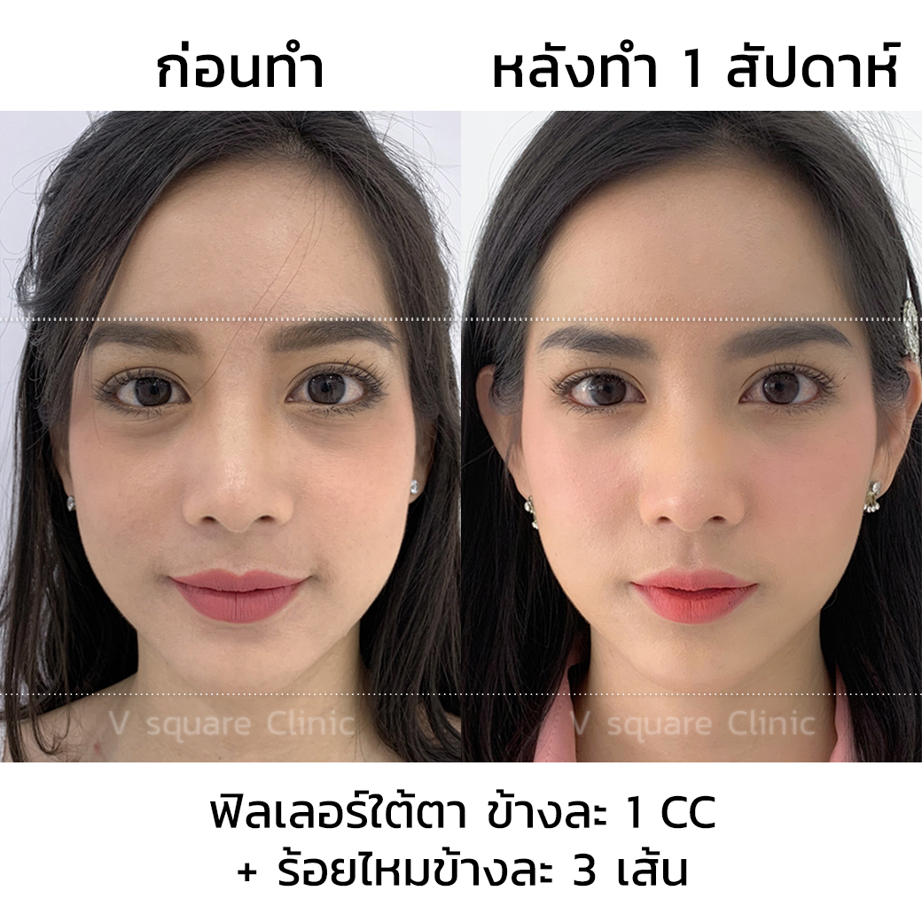 รีวิวฉีดฟิลเลอร์ใต้ตา 1 CC