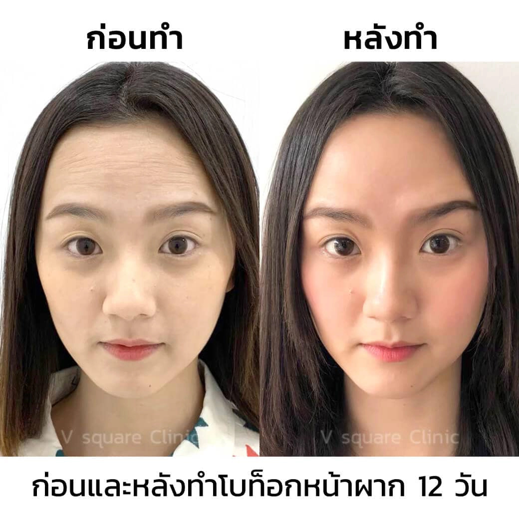 รีวิวฉีดโบท็อกหน้าผาก ก่อน-หลัง 12 วัน