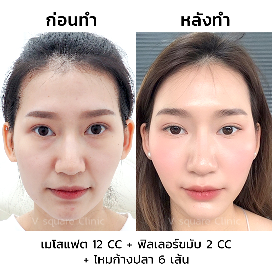 ภาพรีวิวหลังฉีดฟิลเลอร์ขมับ