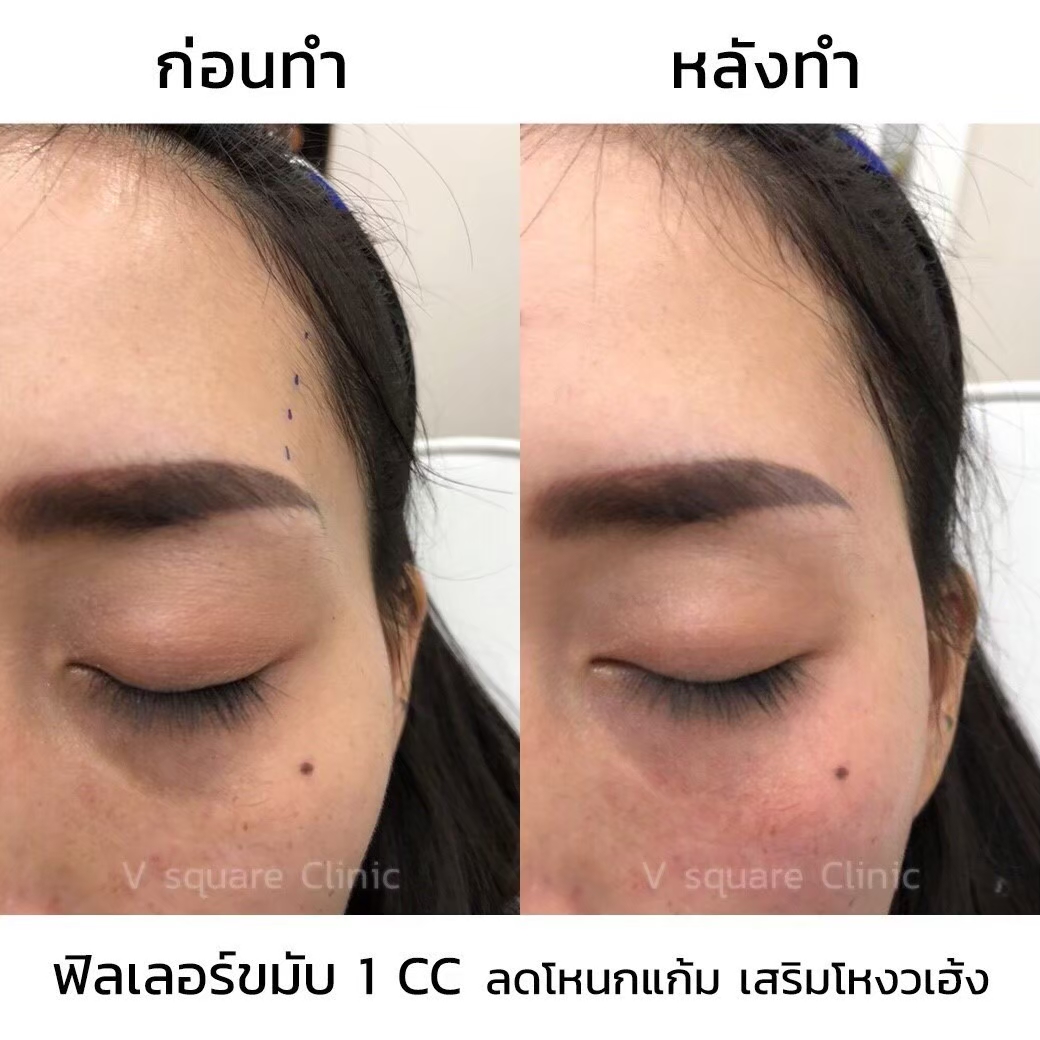 รีวิวก่อน-หลังฉีดฟิลเลอร์ขมับ