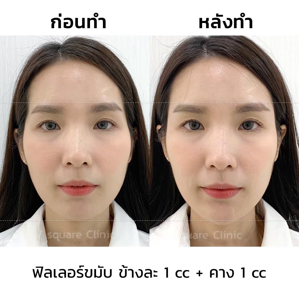 รีวิวหลังฉีดฟิลเลอร์ขมับ